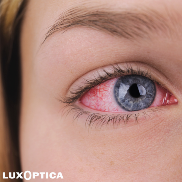 Luxoptica, votre opticien lunetier spécialisé dans les produits d'optique depuis plus de 25 ans, vous recommande l'utilisation de collyres hydratants pour soulager efficacement les symptômes de sécheresse oculaire